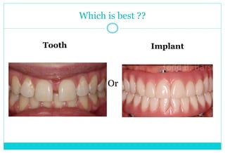 Which is best ??
Tooth
Or
Implant
 