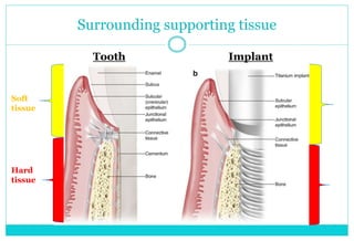 Surrounding supporting tissue
Tooth Implant
Soft
tissue
Hard
tissue
 