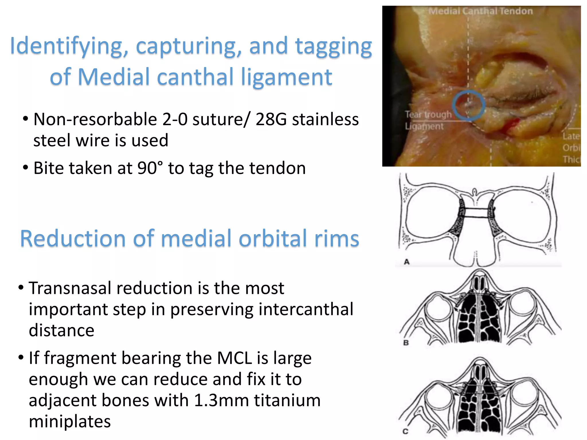 Naso-orbital-ethmoid (NOE) fractures: Management principles, options ...