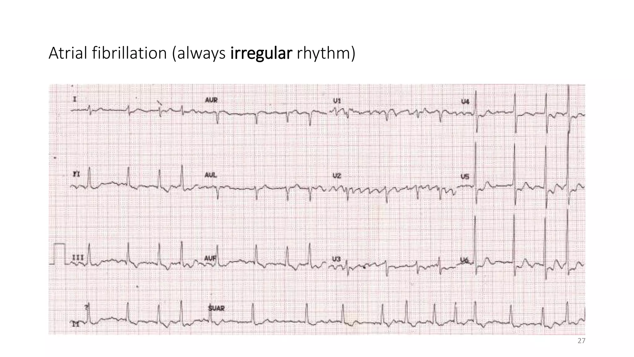 Pediatric ECG Notes | PPTX