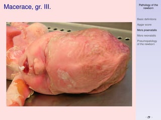 Pathology of the
Macerace, gr. III.       newborn



                     Basic deﬁnitions

                     Apgar score

                     Mors praenatalis

                     Mors neonatalis

                     Pneumopatology
                     of the newborn
 