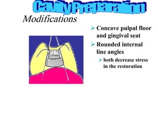 Modifications
 Concave pulpal floor
and gingival seat
 Rounded internal
line angles
both decrease stress
in the restoration
View from distal surface
of primary 1st molar
B L
 