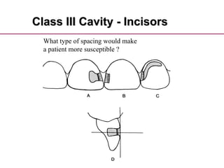 Class III Cavity - Incisors
What type of spacing would make
a patient more susceptible ?
 