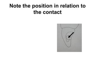 Note the position in relation to
the contact
 