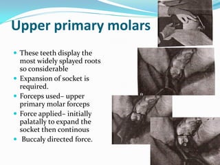 Upper primary molars
 These teeth display the
most widely splayed roots
so considerable
 Expansion of socket is
required.
 Forceps used– upper
primary molar forceps
 Force applied– initially
palatally to expand the
socket then continous
 Buccaly directed force.
 