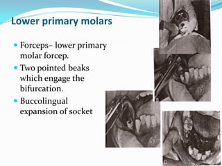 Lower primary molars
 Forceps– lower primary
molar forcep.
 Two pointed beaks
which engage the
bifurcation.
 Buccolingual
expansion of socket
 