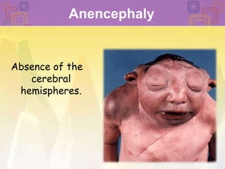 Anencephaly Absence of the cerebral hemispheres. 