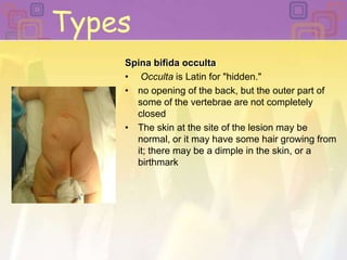 TypesSpina bifida occultaOcculta is Latin for "hidden." no opening of the back, but the outer part of some of the vertebrae are not completely closed The skin at the site of the lesion may be normal, or it may have some hair growing from it; there may be a dimple in the skin, or a birthmark