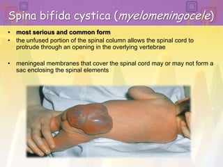 Spina bifida cystica (myelomeningocele)most serious and common form the unfused portion of the spinal column allows the spinal cord to protrude through an opening in the overlying vertebrae meningeal membranes that cover the spinal cord may or may not form a sac enclosing the spinal elements 
