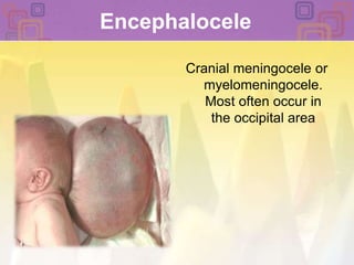 EncephaloceleCranial meningocele or myelomeningocele. Most often occur in the occipital area 