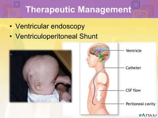 Therapeutic Management Ventricular endoscopyVentriculoperitoneal Shunt 