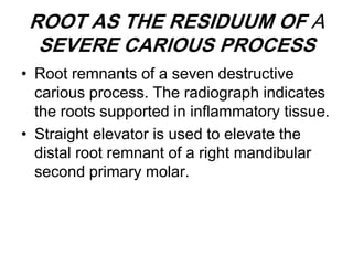 ROOT AS THE RESIDUUM OF A
SEVERE CARIOUS PROCESS
• Root remnants of a seven destructive
carious process. The radiograph indicates
the roots supported in inflammatory tissue.
• Straight elevator is used to elevate the
distal root remnant of a right mandibular
second primary molar.
 