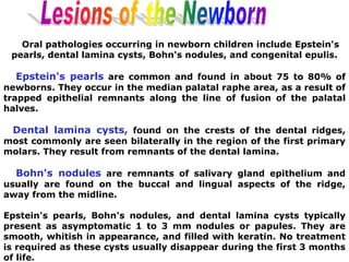 Oral pathologies occurring in newborn children include Epstein's
pearls, dental lamina cysts, Bohn's nodules, and congenital epulis.
Epstein's pearls are common and found in about 75 to 80% of
newborns. They occur in the median palatal raphe area, as a result of
trapped epithelial remnants along the line of fusion of the palatal
halves.
Dental lamina cysts, found on the crests of the dental ridges,
most commonly are seen bilaterally in the region of the first primary
molars. They result from remnants of the dental lamina.
Bohn's nodules are remnants of salivary gland epithelium and
usually are found on the buccal and lingual aspects of the ridge,
away from the midline.
Epstein's pearls, Bohn's nodules, and dental lamina cysts typically
present as asymptomatic 1 to 3 mm nodules or papules. They are
smooth, whitish in appearance, and filled with keratin. No treatment
is required as these cysts usually disappear during the first 3 months
of life.
 