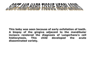 This baby was seen because of early exfoliation of teeth.
A biopsy of the gingiva adjacent to the mandibular
incisors rendered the diagnosis of Langerhans's cell
histiocytosis. This child developed the acute
disseminated variety.
 