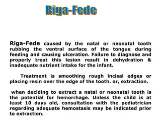 Riga-Fede caused by the natal or neonatal tooth
rubbing the ventral surface of the tongue during
feeding and causing ulceration. Failure to diagnose and
properly treat this lesion result in dehydration &
inadequate nutrient intake for the infant.
Treatment is smoothing rough incisal edges or
placing resin over the edge of the tooth. or, extraction.
when deciding to extract a natal or neonatal tooth is
the potential for hemorrhage. Unless the child is at
least 10 days old, consultation with the pediatrician
regarding adequate hemostasis may be indicated prior
to extraction.
 
