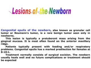 Congenital epulis of the newborn, also known as granular cell
tumor or Neumann's tumor, is a rare benign tumor seen only in
newborns.
This lesion is typically a protuberant mass arising from the
gingival mucosa. It is most often found on the anterior maxillary
ridge.
Patients typically present with feeding and/or respiratory
problems. Congenital epulis has a marked predilection for females at
8-10:1.
Treatment normally consists of surgical excision. The newborn
usually heals well and no future complications or treatment should
be expected
 