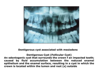 Dentigerous cyst associated with mesiodens
Dentigerous Cyst (Follicular Cyst)
An odontogenic cyst that surrounds the crown f an impacted tooth;
caused by fluid accumulation between the reduced enamel
epithelium and the enamel surface, resulting in a cyst in which the
crown is located within the lumen and root (s) outside
 