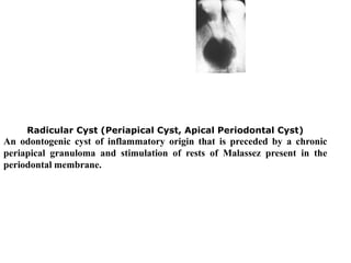 Radicular Cyst (Periapical Cyst, Apical Periodontal Cyst)
An odontogenic cyst of inflammatory origin that is preceded by a chronic
periapical granuloma and stimulation of rests of Malassez present in the
periodontal membrane.
 