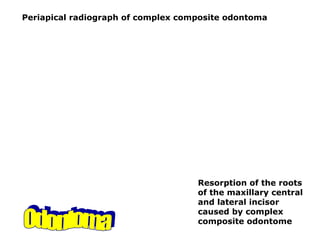 Periapical radiograph of complex composite odontoma
Resorption of the roots
of the maxillary central
and lateral incisor
caused by complex
composite odontome
 