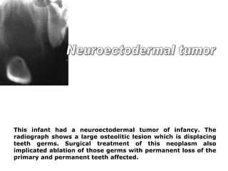 This infant had a neuroectodermal tumor of infancy. The
radiograph shows a large osteolitic lesion which is displacing
teeth germs. Surgical treatment of this neoplasm also
implicated ablation of those germs with permanent loss of the
primary and permanent teeth affected.
 
