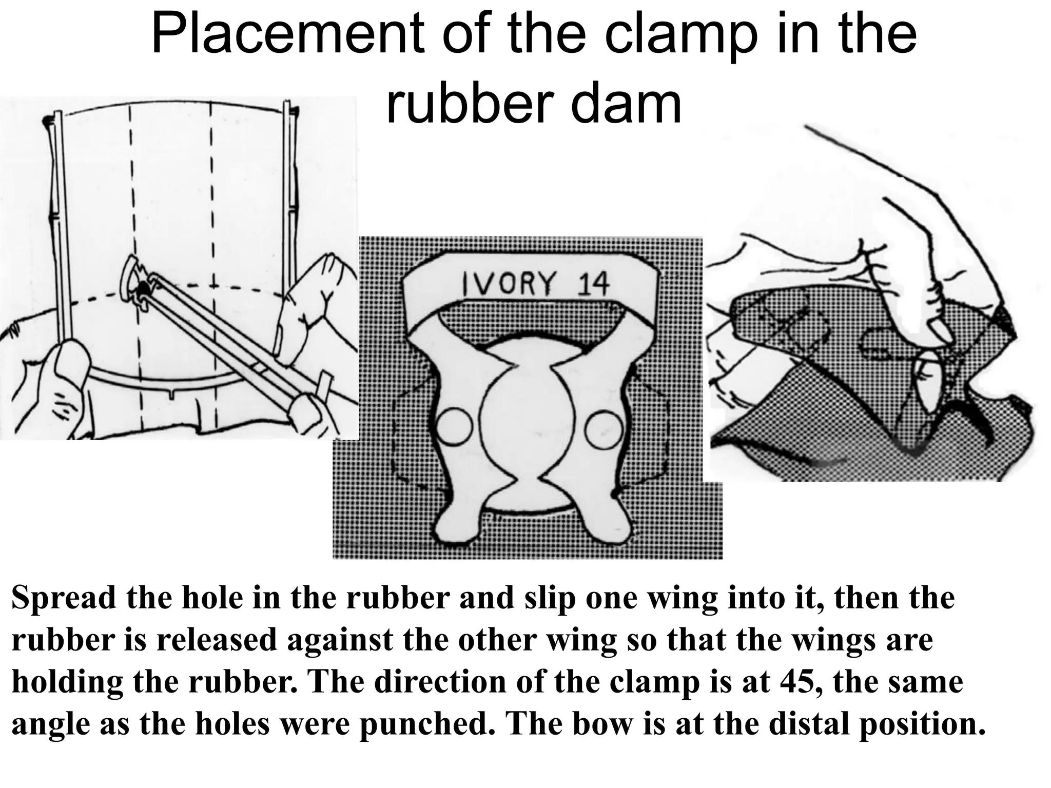 Spread the hole in the rubber and slip one wing into it, then the
rubber is released against the other wing so that the wings are
holding the rubber. The direction of the clamp is at 45, the same
angle as the holes were punched. The bow is at the distal position.
Placement of the clamp in the
rubber dam