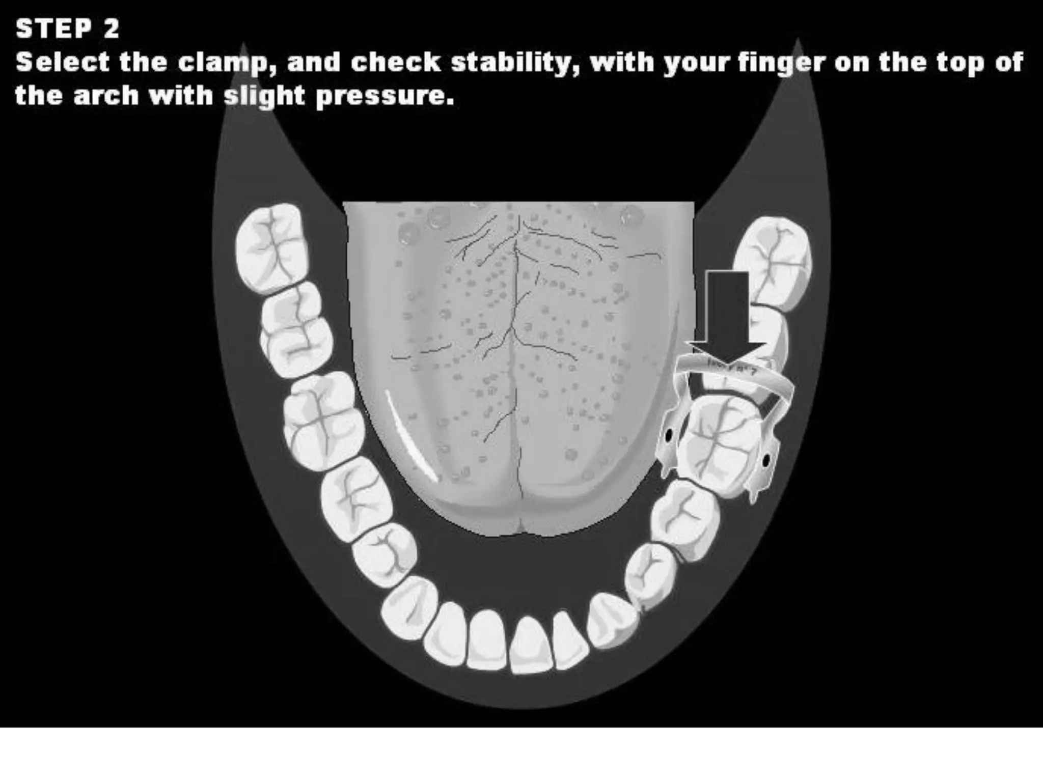 Pedia Rubber Dam application