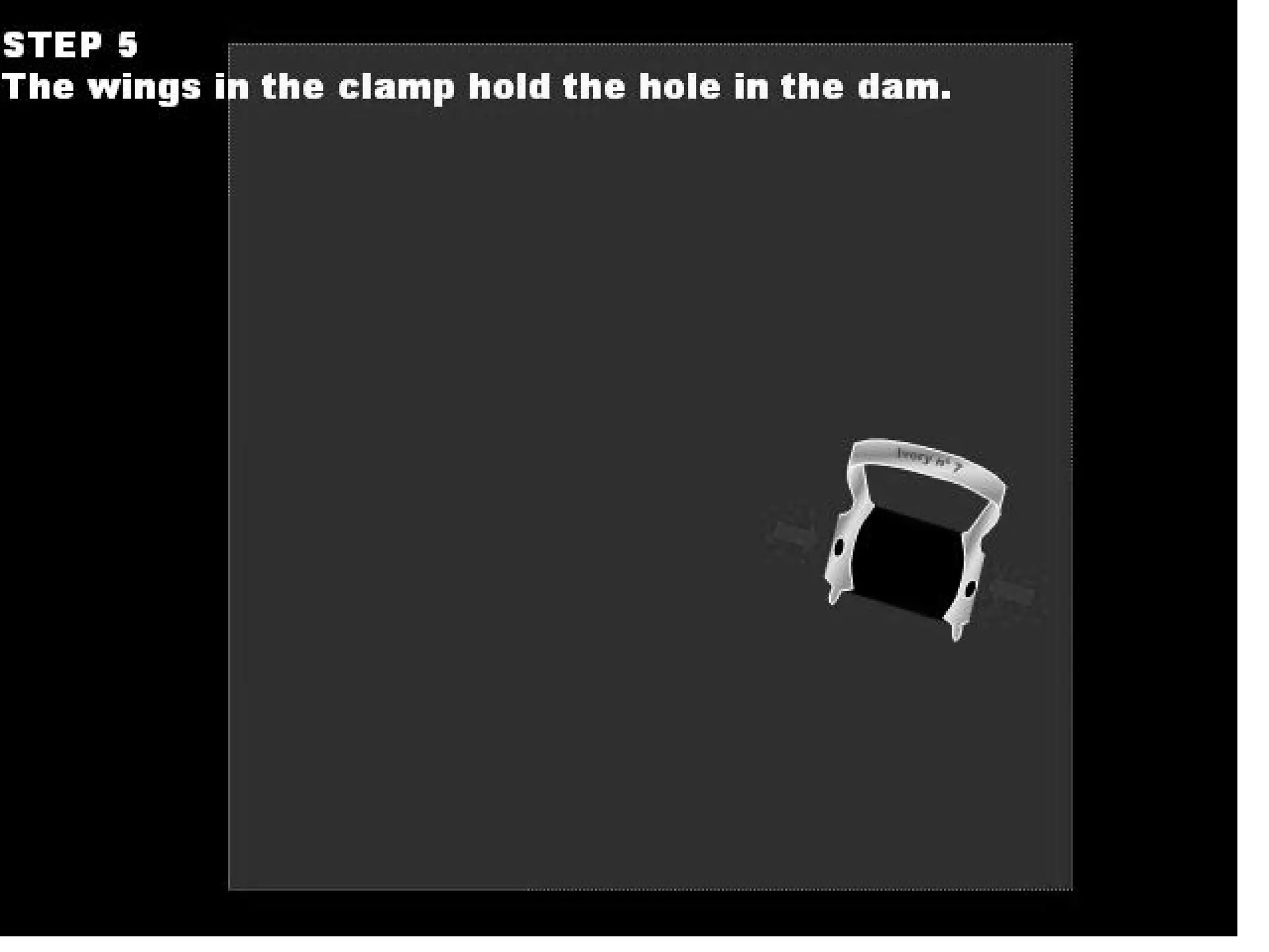 Pedia Rubber Dam application