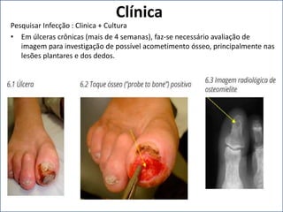 Clínica
Pesquisar Infecção : Clinica + Cultura
• Em úlceras crônicas (mais de 4 semanas), faz-se necessário avaliação de
imagem para investigação de possível acometimento ósseo, principalmente nas
lesões plantares e dos dedos.
 