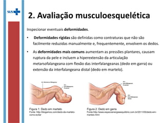 2. Avaliação musculoesquelética
Inspecionar eventuais deformidades.
• Deformidades rígidas são definidas como contraturas que não são
facilmente reduzidas manualmente e, frequentemente, envolvem os dedos.
• As deformidades mais comuns aumentam as pressões plantares, causam
ruptura da pele e incluem a hiperextensão da articulação
metarsofalangeana com flexão das interfalangeanas (dedo em garra) ou
extensão da interfalangeana distal (dedo em martelo).
Figura 1: Dedo em martelo
Fonte: http://blogamos.com/dedo-de-martelo-
como-evitar
Figura 2: Dedo em garra
Fonte:http://www.espacoenergiaeequilibrio.com.br/2011/05/dedo-em-
martelo.html
 