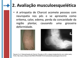 2. Avaliação musculoesquelética
• A artropatia de Charcot acomete pessoas com
neuropatia nos pés e se apresenta como
eritema, calor, edema, perda da concavidade da
região plantar, causando uma grosseira
deformidade.
Figuras 3 e 4: Osteoartropatia de Charcot: Perceba no RX o colapso longitudinal do arco médio (seta).
Fonte: http://www.unifesp.br/denf/NIEn/PEDIABETICO/mestradositecopia/pages/charcot.htm
 