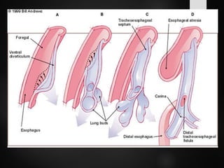 Tef Radiology Tracheoesophageal Fistula || TEF || Esophageal fistula | PDF