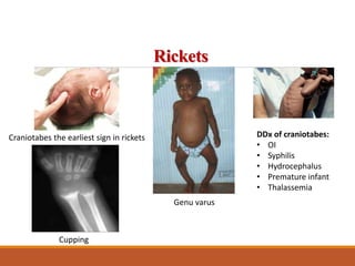 Head In Rickets Pediatrics OSCE pictures part 2 | PPTX
