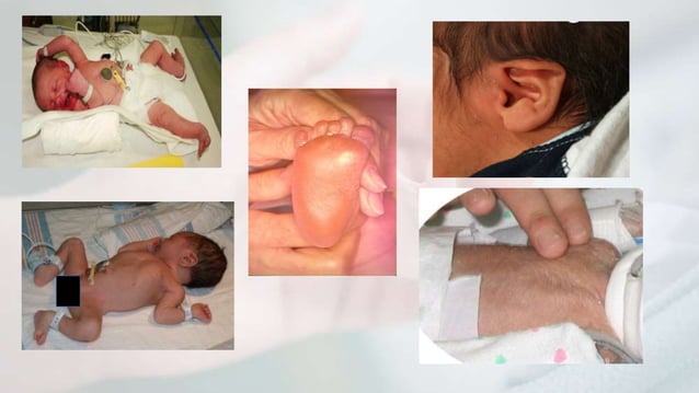 Nursing management of Preterm, Term, Post-term and IUGR Baby.pptx