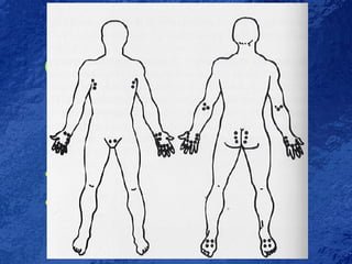 Scabies Body Distribution Pediatic | PPT