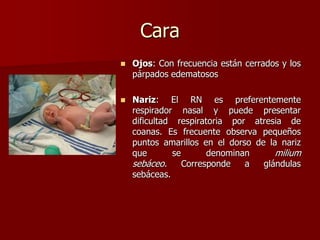 Cara
 Ojos: Con frecuencia están cerrados y los
párpados edematosos
 Nariz: El RN es preferentemente
respirador nasal y puede presentar
dificultad respiratoria por atresia de
coanas. Es frecuente observa pequeños
puntos amarillos en el dorso de la nariz
que se denominan milium
sebáceo. Corresponde a glándulas
sebáceas.
 