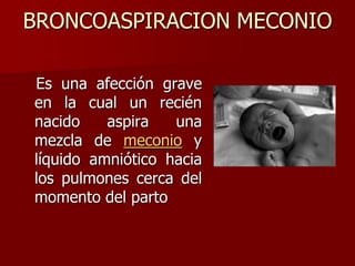 BRONCOASPIRACION MECONIO
Es una afección grave
en la cual un recién
nacido aspira una
mezcla de meconio y
líquido amniótico hacia
los pulmones cerca del
momento del parto
 