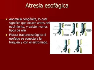 Atresia esofágica
 Anomalía congénita, lo cual
significa que ocurre antes del
nacimiento, y existen varios
tipos de ella
 Fistula traqueoesofagica el
esofago se conecta a la
traquea y con el estromago.
 