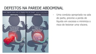 DEFEITOS NA PAREDE ABDOMINAL
- Uma conduta apropriada na sala
de parto, previne a perda de
líquido em excesso e minimiza o
risco de lesionar uma víscera.
 