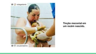 Tinção meconial em
um recém nascido.
 