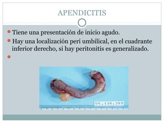 APENDICITIS

Tiene una presentación de inicio agudo.
Hay una localización peri umbilical, en el cuadrante
 inferior derecho, si hay peritonitis es generalizado.

 