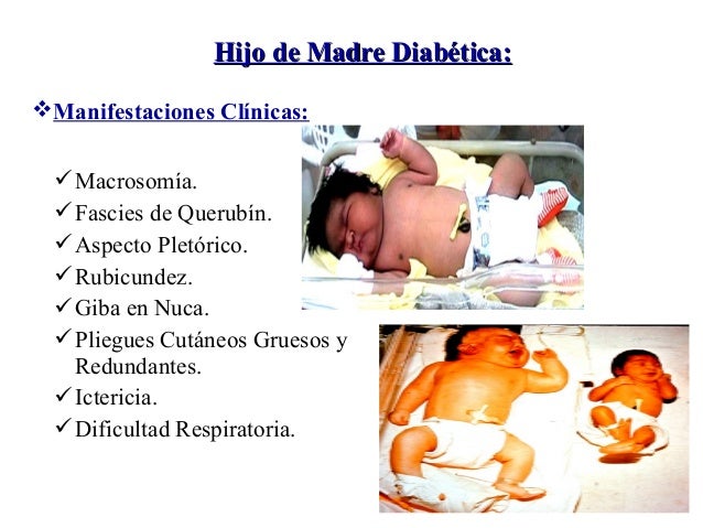 Hijos de madre diabetica