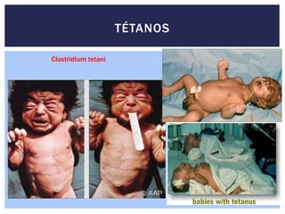 TÉTANOS
Clostridium tetani
 