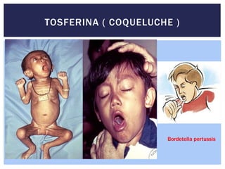 TOSFERINA ( COQUELUCHE )
Bordetella pertussis
 