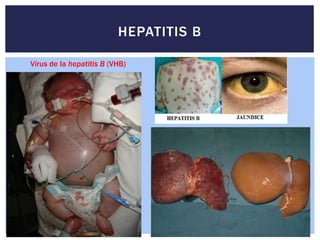 HEPATITIS B
Vírus de la hepatitis B (VHB)
 