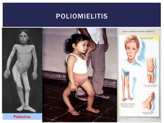 POLIOMIELITIS
Poliovírus
 
