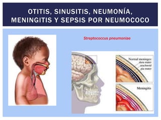 OTITIS, SINUSITIS, NEUMONÍA,
MENINGITIS Y SEPSIS POR NEUMOCOCO
Streptococcus pneumoniae
 