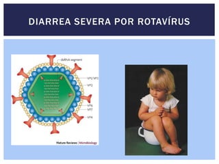 DIARREA SEVERA POR ROTAVÍRUS
 
