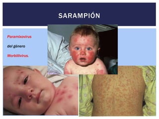 SARAMPIÓN
Paramixovirus
del género
Morbillivirus.
 