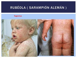 RUBÉOLA ( SARAMPIÓN ALEMÁN )
Togavírus
 