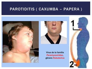 PAROTIDITIS ( CAXUMBA – PAPERA )
Vírus de la família
Paramyxoviridae,
gênero Rubulavirus
 